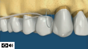 uso de fio dental em pontes fixas