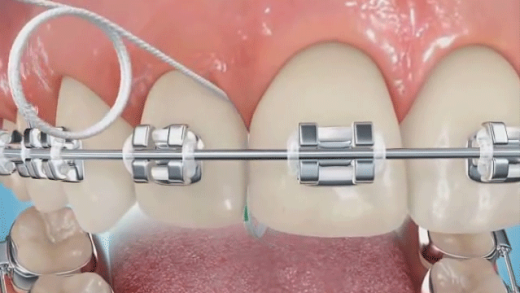 Veja como utilizar seu fio dental entre o aparelho ortodôntico com o auxílio de um passa-fio
