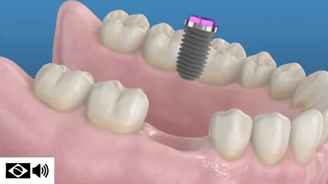 Implantes dentais substituem dentes perdidos, ao implantar-se uma raiz artificial ao osso