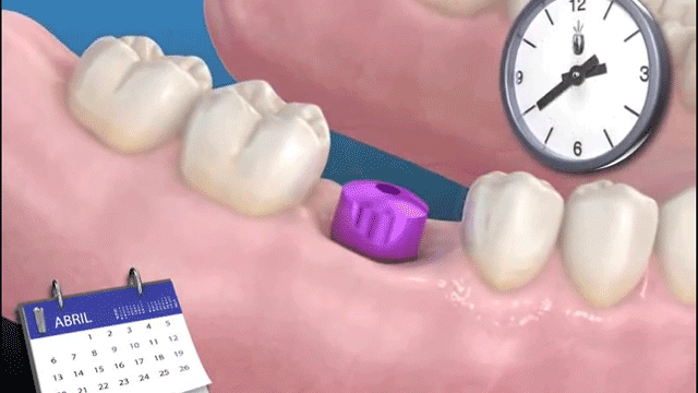 Implantes dentais substituem dentes perdidos, ao implantar-se uma raiz artificial ao osso
