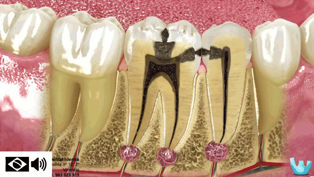 cárie e restauração dental
