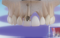 Implante dentário ou ponte fixa?