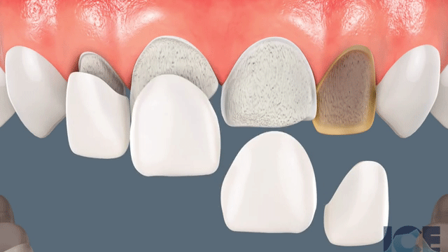 Facetas de porcelana sendo aplicadas em dentes lascados, quebrados e escurecidos