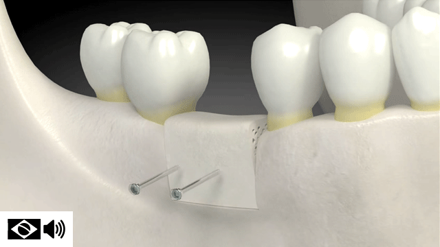 Enxerto ósseo dentário usado para criar uma condição mais favorável para um implante dentário