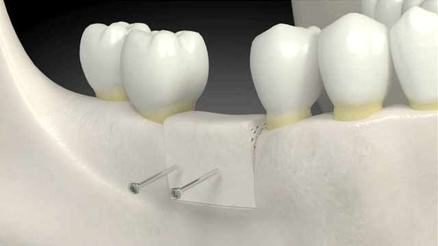 Enxerto ósseo dentário usado para criar uma condição mais favorável para um implante dentário